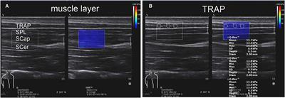 Increased Stiffness of the Superficial Cervical Extensor Muscles in Patients With Cervicogenic Headache: A Study Using Shear Wave Elastography